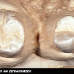 Knochenverlust nach der Zahnextraktion